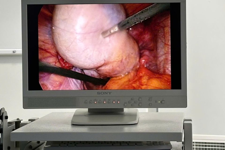 3 giờ “nghẹt thở” bóc tách khối u buồng trứng 10 cm cho bệnh nhân Gen Z tại Phú Quốc
