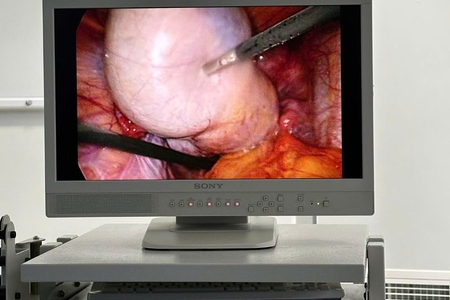 3 giờ “nghẹt thở” bóc tách khối u buồng trứng 10 cm cho bệnh nhân Gen Z tại Phú Quốc