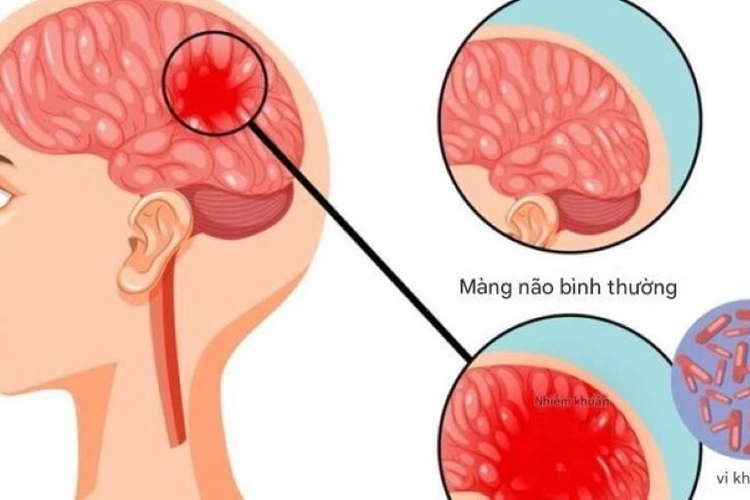 Bệnh não mô cầu có thể gây tử vong nhanh, chuyên gia cảnh báo những dấu hiệu nguy hiểm